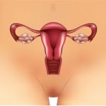 tratamiento de quistes de ovario en León, Gto