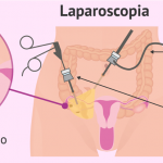 cirugia laparoscopica en leon gto