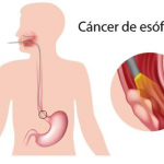 cirugia laparoscopica en leon gto