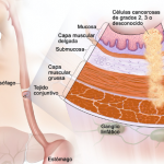 tratamiento de cancer en leon gto