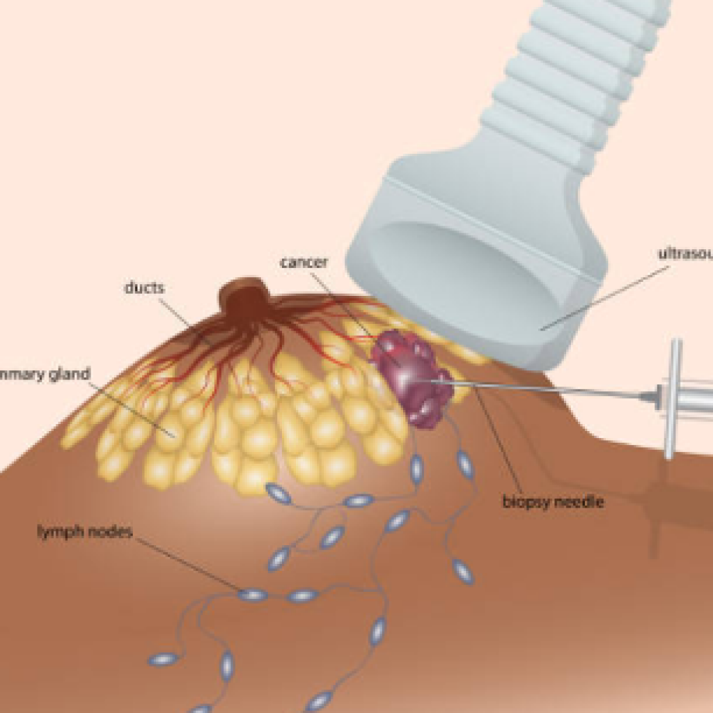 Biopsia de mama en León Gto