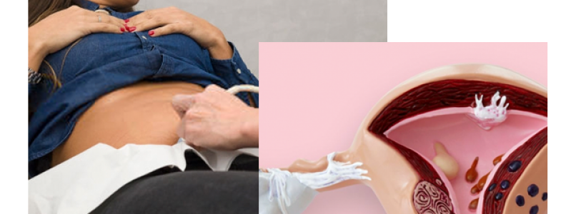 ¿Qué es la histerectomía?