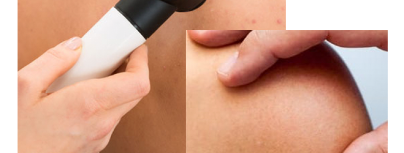 ¿Es posible prevenir el cáncer de piel?