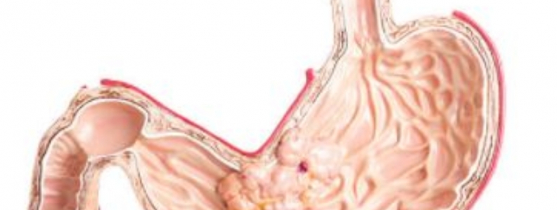 ¿Qué es el cáncer de esófago?